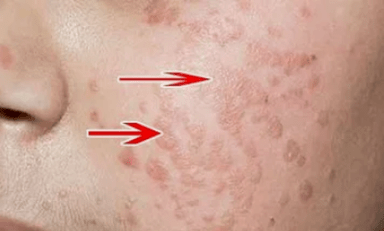kako prepoznati virus človeškega papiloma