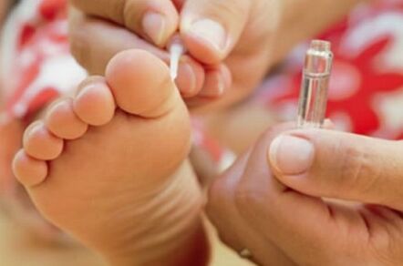 Metode za zdravljenje plantarnih bradavic