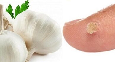 zdravljenje bradavic z ljudskimi zdravili