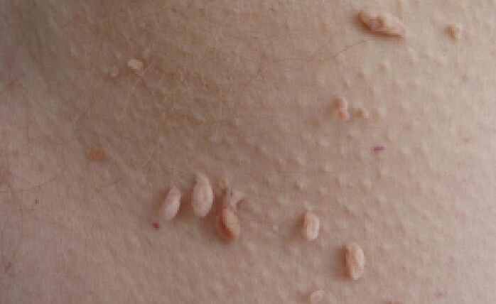 vzroki za pojav papiloma na človeškem telesu