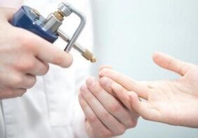 sodobne metode odstranjevanja papiloma