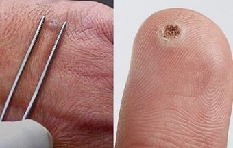 simptomi papiloma na človeškem telesu