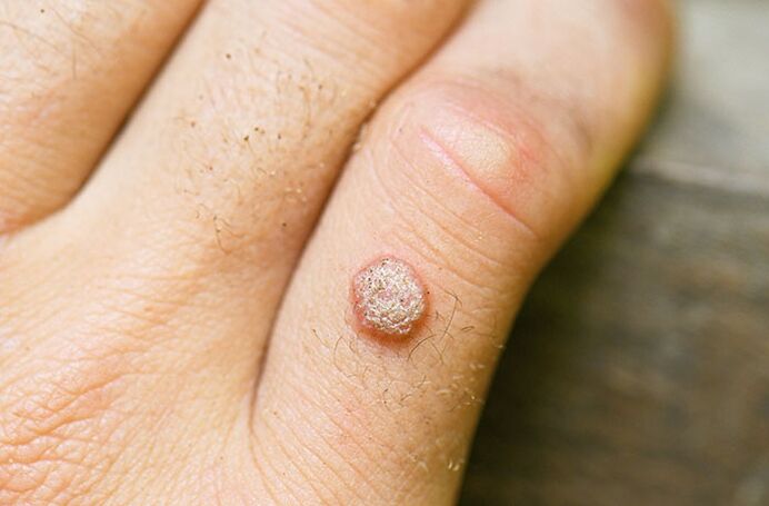Pri okužbi s HPV se lahko na roki ali drugem delu telesa pojavi bradavica